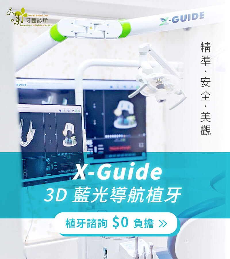 X-Guide  3D 藍光導航植牙
