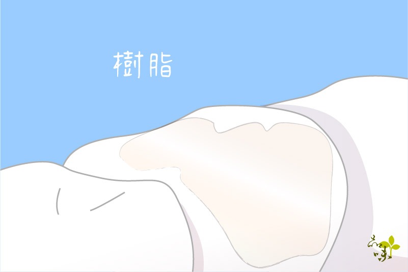 樹脂－最常見的補牙方式
