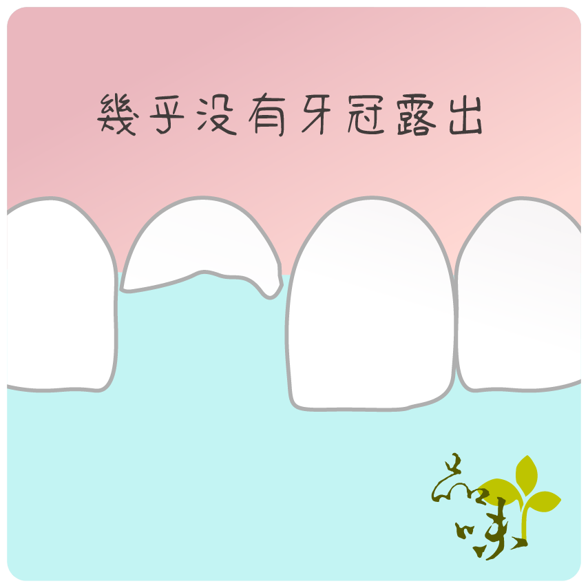 殘留牙根幾乎沒有牙冠露出的情況