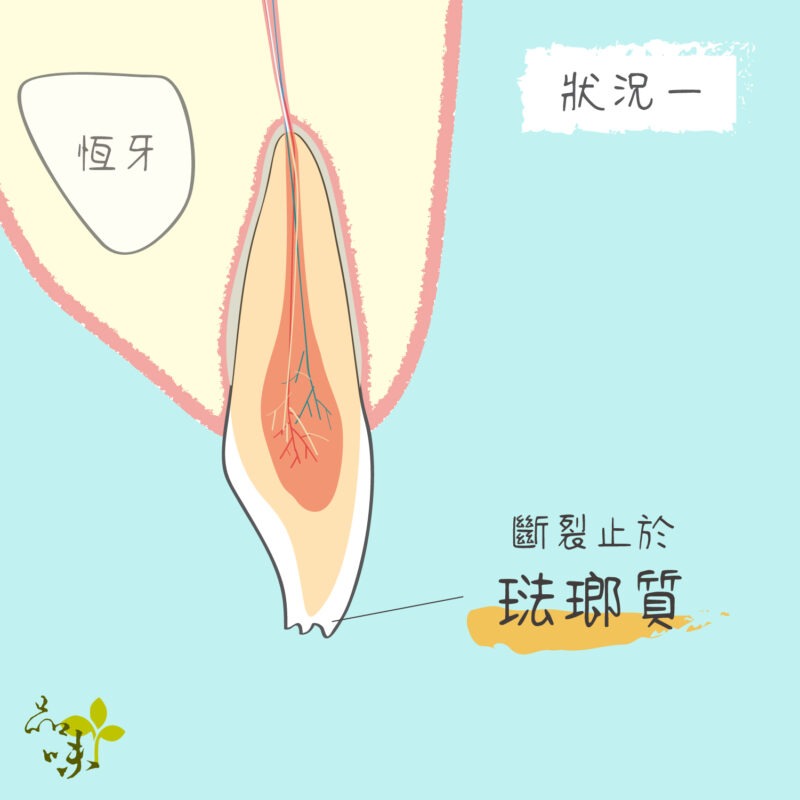 牙齒斷裂