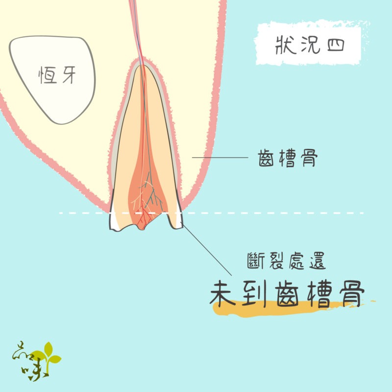 牙齒斷裂