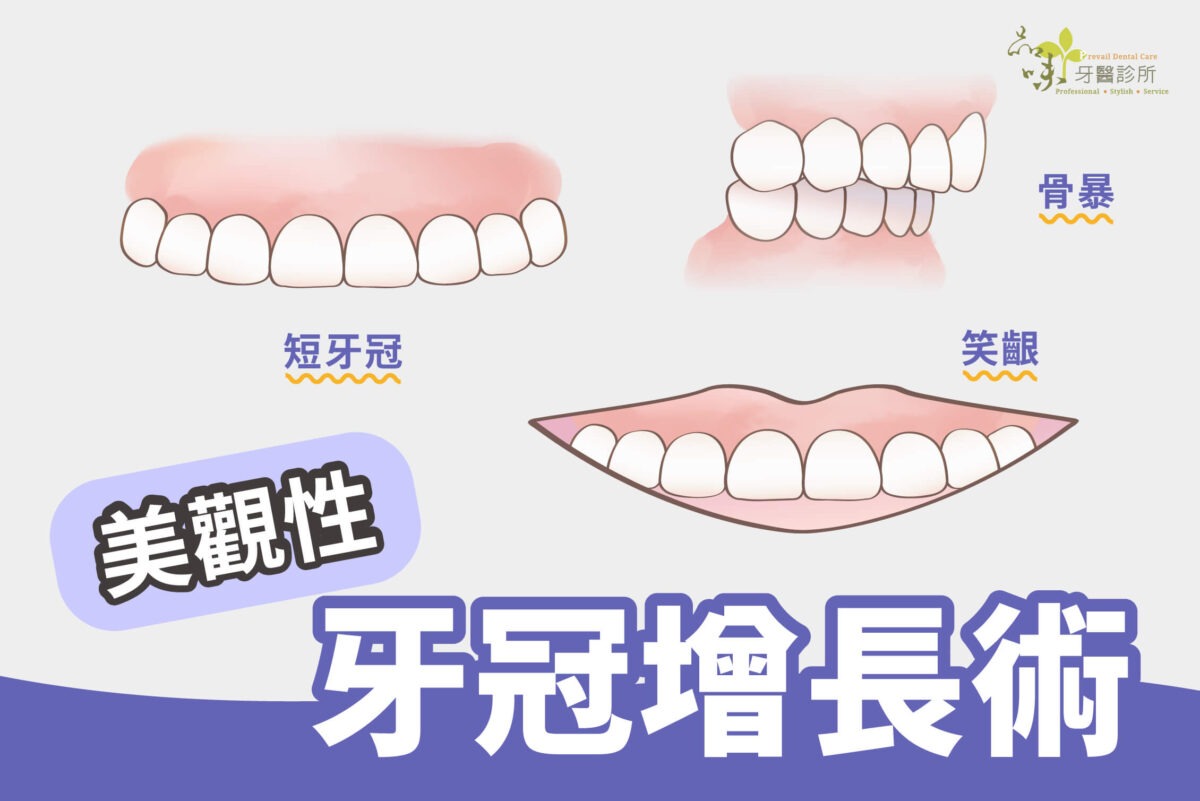 美觀性牙冠增長術