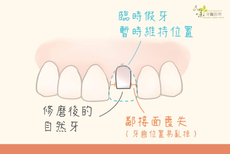 一排牙齒有一顆修得小小的旁邊沒有貼著的齒質