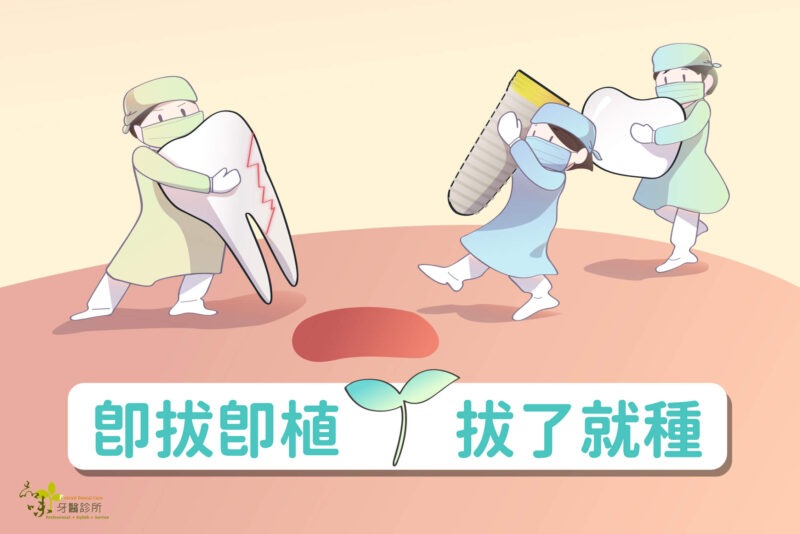 拔牙當天就植牙，即拔即植縮短缺牙重建時間