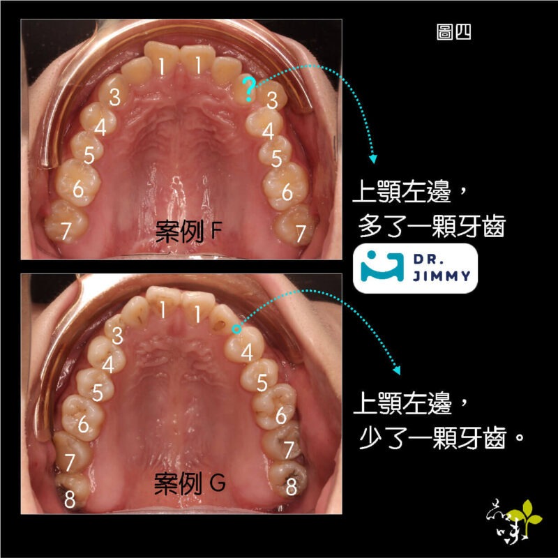 蔡騏駿矯正案例多生牙