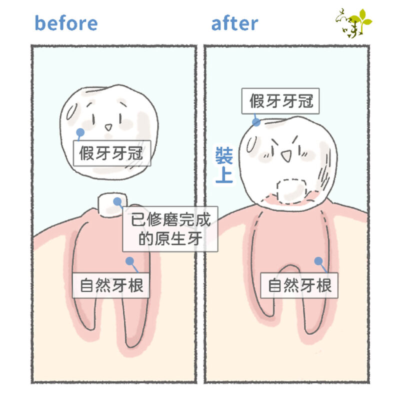 自然牙根裝假牙
