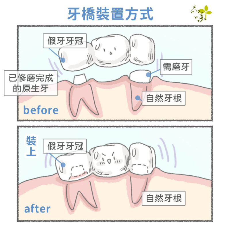 牙橋安裝