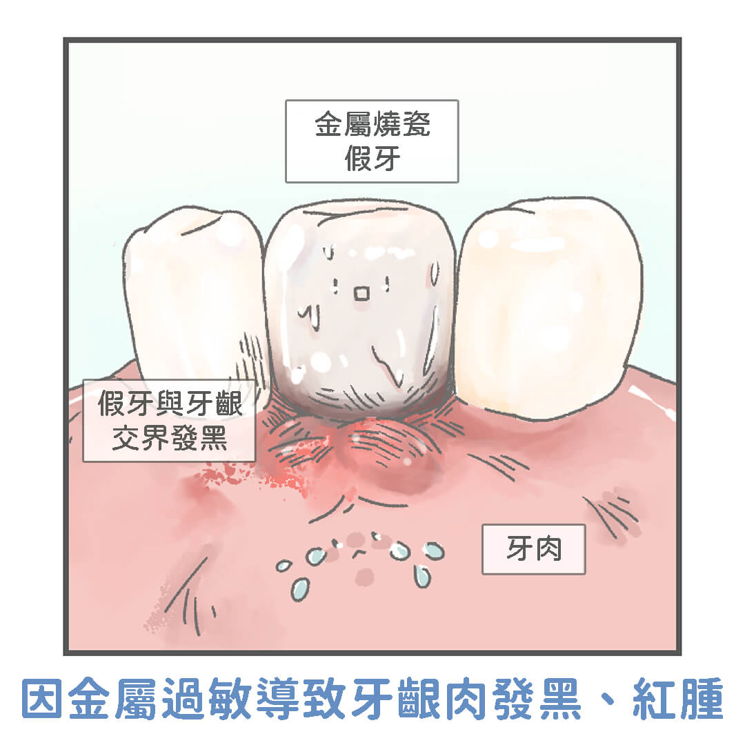 不良金屬假牙導致牙齦發黑過敏