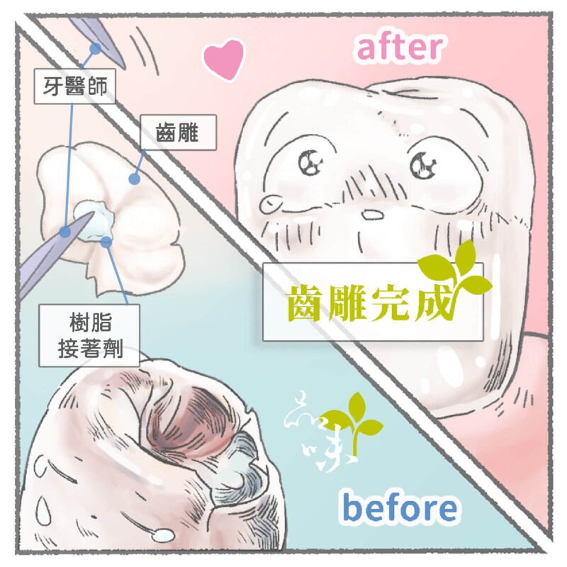 安裝齒雕