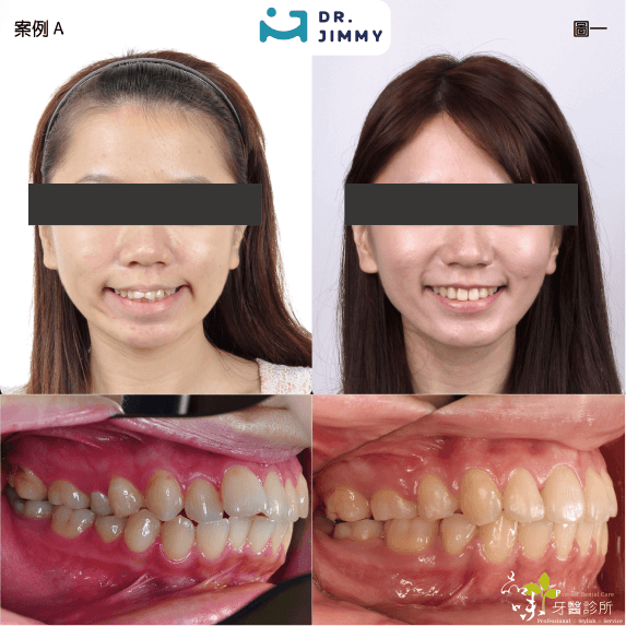 蔡騏駿矯正案例一正面