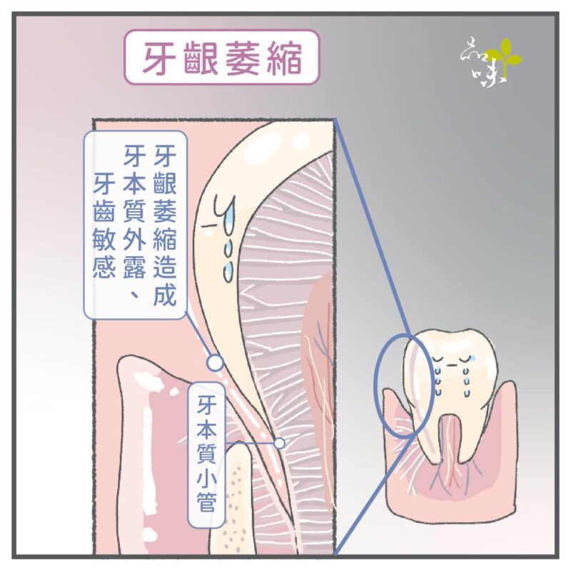 牙齦萎縮造成牙本質外露