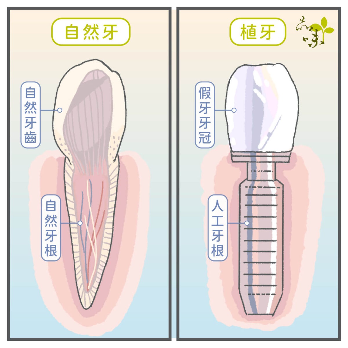 自然真牙與植牙剖面圖比較