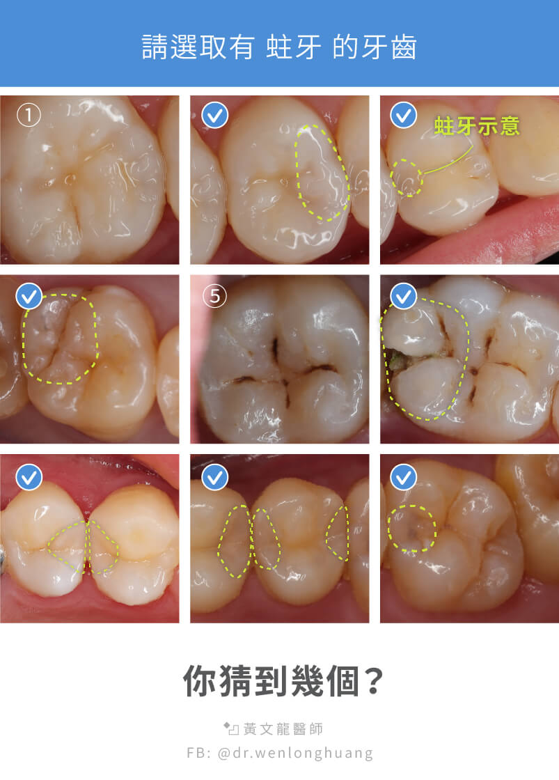 牙齒蛀牙猜謎九宮格解答有六個牙齒蛀牙