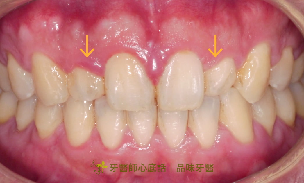 case2郭彥君醫師的美白貼片術前照片