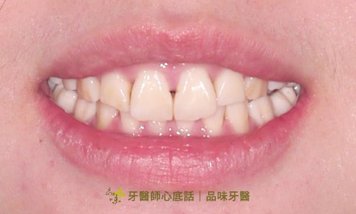 case1郭彥君醫師的美白貼片術前照片