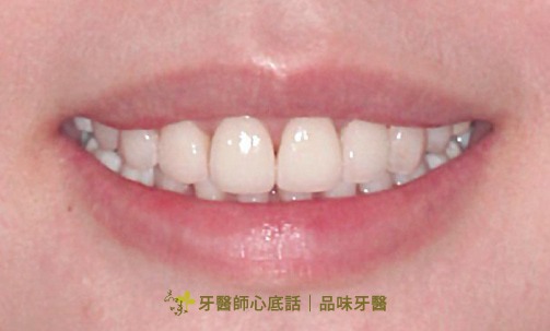 case1郭彥君醫師的美白貼片術後照片