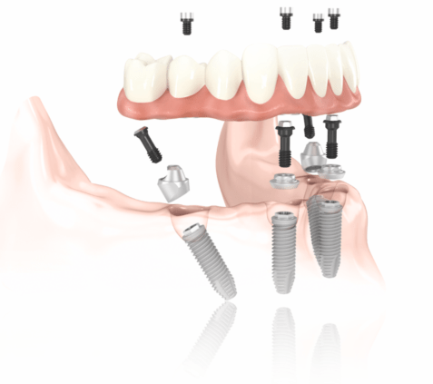 四支或以上的植體作跨顎的連接。如此便有極高的機會達成植牙後立即承載咬合力量