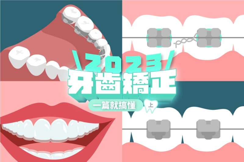 【2023牙齒矯正懶人包】傳統矯正、戴蒙、舌側、隱形矯正
