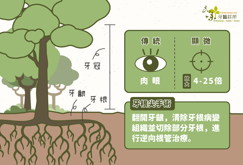 在講根尖手術前要先了解什麼是根尖。 根尖,好比是一棵大樹的樹根,也像一棟房子的地基牢牢地抓住地面穩固整棟房子整棵樹,而根尖手術就像是將土壤撥開針對生病的樹根進行治療。