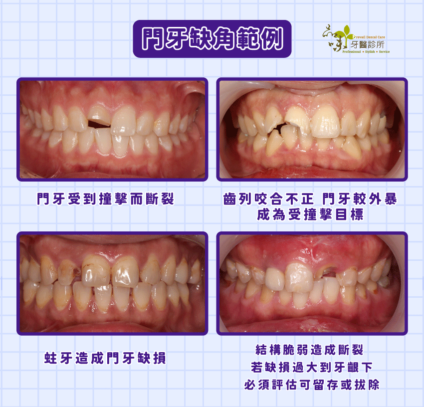 門牙缺角不同原因的案例照