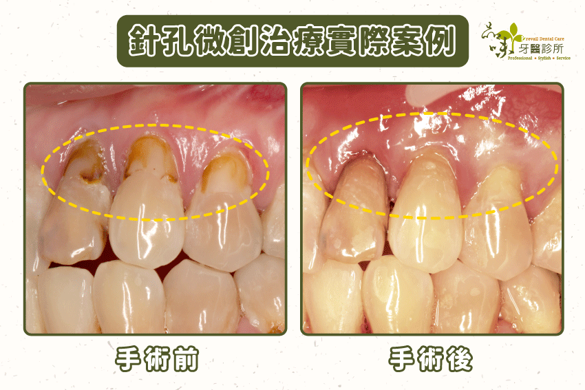 針孔微創治療實際案例