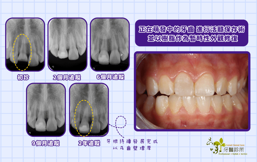 門牙缺角修復案例