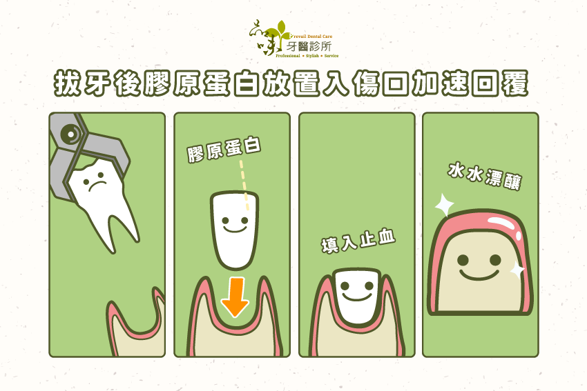 拔牙後填入膠原蛋白，可以減少傷口疼痛、加速傷口癒合、止血…...等等的效果，對於拔牙傷口上是有很顯著的表現。