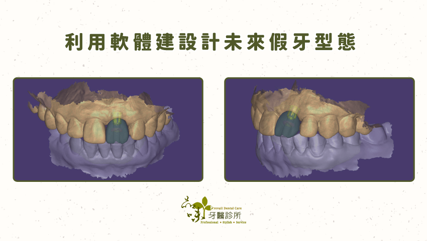 假牙製作時，利用軟體建設計未來假牙型態