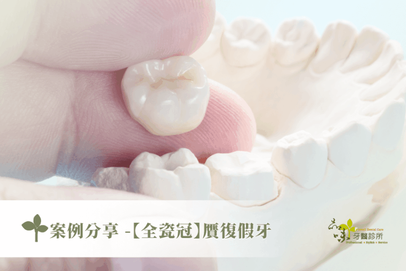 案例分享 -【全瓷冠】贋復假牙
