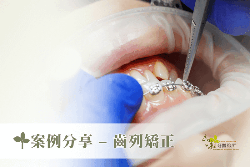 案例分享 – 齒列矯正