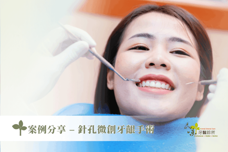 案例分享 – 針孔微創牙齦手術