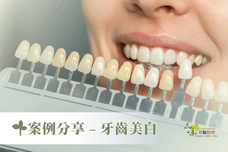 案例分享 – 牙齒美白