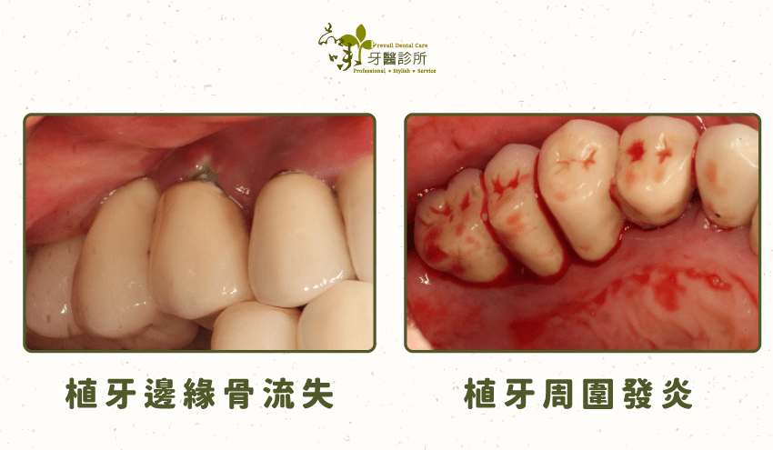 菸草和檳榔會助長牙周致病菌的生長，牙齦血液供應差，使得免疫細胞活性降低，導致植牙周圍組織容易感染。
植牙後，明顯有更多的邊緣骨流失情形，增加植體周圍炎的發生率。