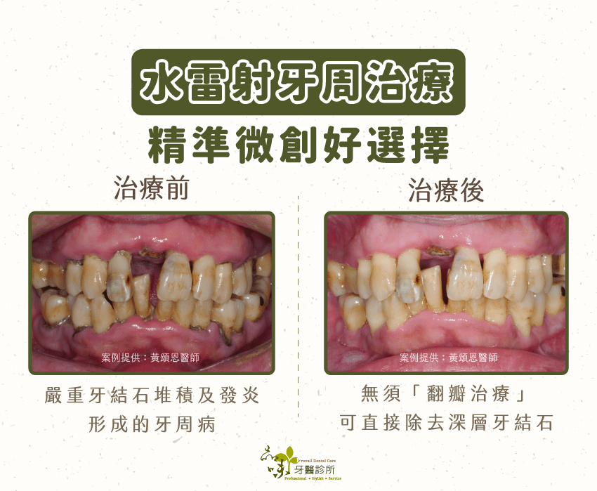 水雷射牙周治療案例，治療前：嚴重牙結石堆積及發炎形成的牙周病；治療後：水雷射無需翻瓣即可清除牙結石。案例提供：黃頌恩醫師品味牙醫